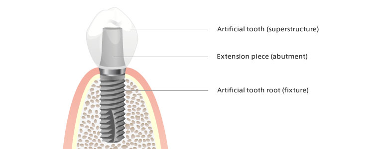 Implant components - Dental Implants Net