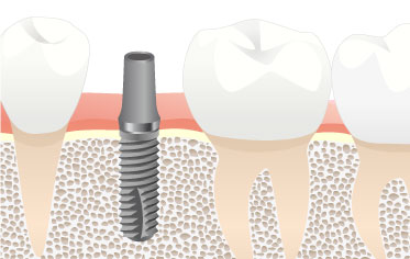 One-stage method - Dental Implants Net