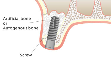 Differences between sinus lift and socket lift