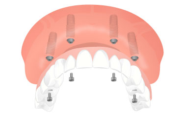 All-on-4 - Dental Implants Net