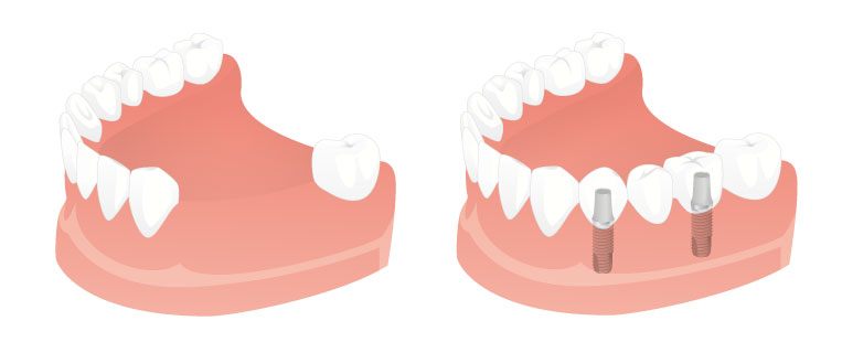 Replacing multiple missing teeth - Dental Implants Net