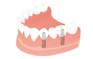 Restoring a natural-looking appearance - Dental Implants Net