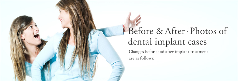 Before&After - Photos of  dental implant cases Changes before and after implant treatment are as follows:
