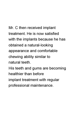 Mr. C then received implant treatment. He is now satisfied with the implants because he has obtained a natural-looking appearance and comfortable chewing ability similar to natural teeth.His teeth and gums are becoming healthier than before implant treatment with regular professional maintenance.