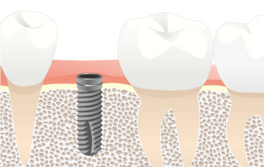 Two-stage method - Dental Implants Net