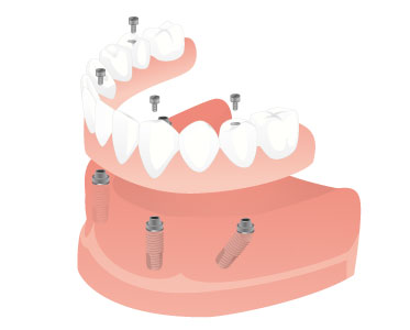 Replacing loss of almost all teeth - Dental Implants Net