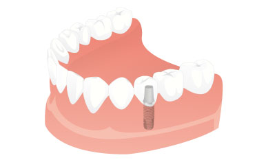 Replacing a single missing tooth - Dental Implants Net